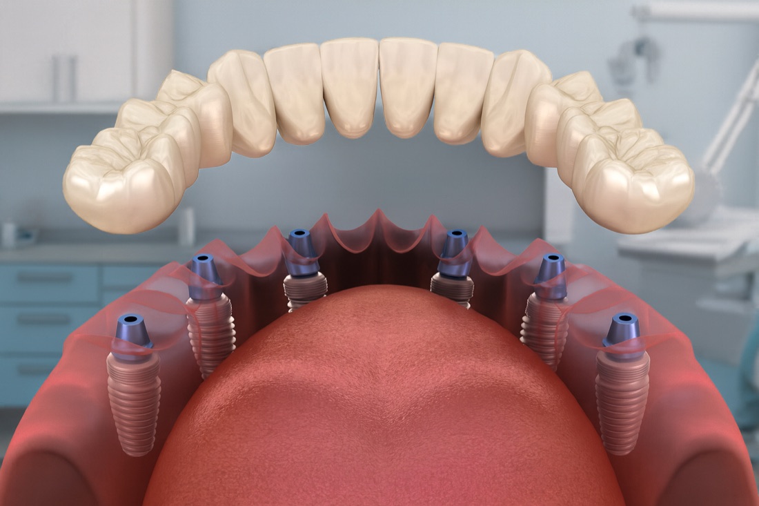 A real winning ad from the campaign: a 3D illustration of a dental implant bridge